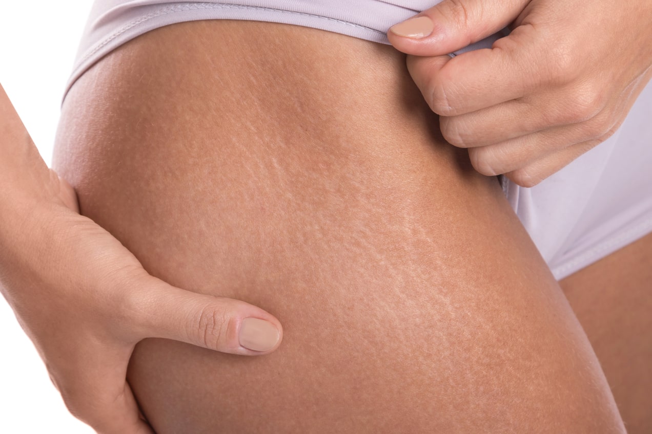 closeup-of-female-hips-with-a-stretch-marks-2023-08-15-20-29-41-utc (1)-min