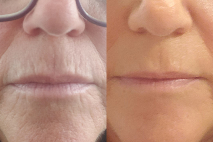Opus-Before-After-Web-Hsu-Post-10-days