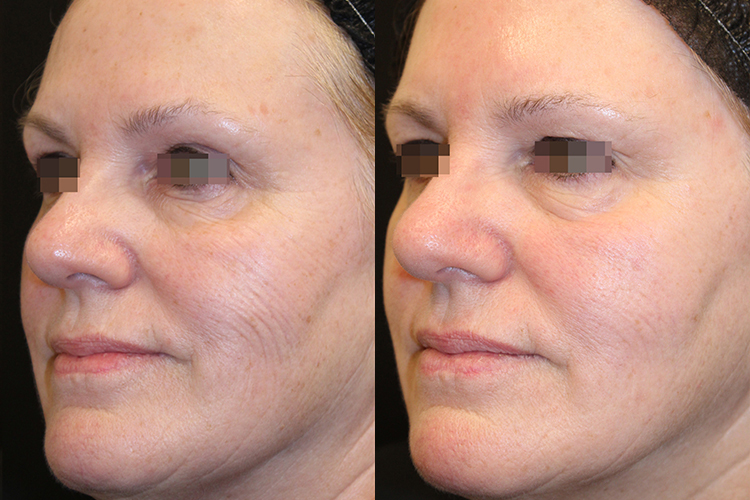 Opus-Before-After-Web-Hsu01-Post-2-txs
