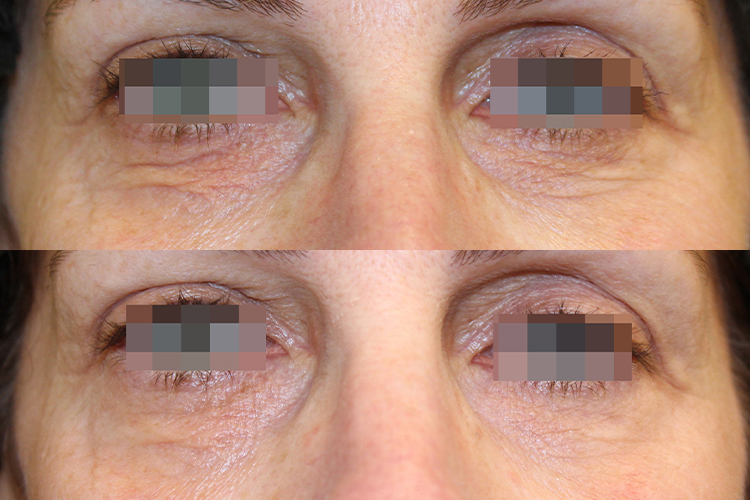 Opus-Before-After-Web-Hsu02-Post-`txs