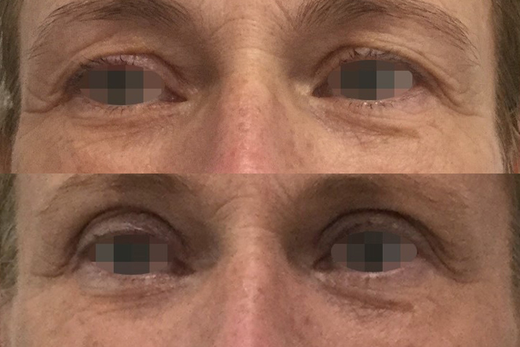 Opus-Before-After-Web-Post-4txs