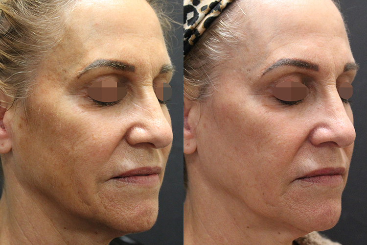 Opus-Before-After-Web-Shraddha06-3-month-post