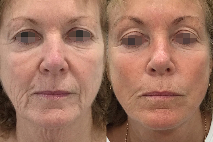 Opus-Before-After-Web-Smith-Post-4txs