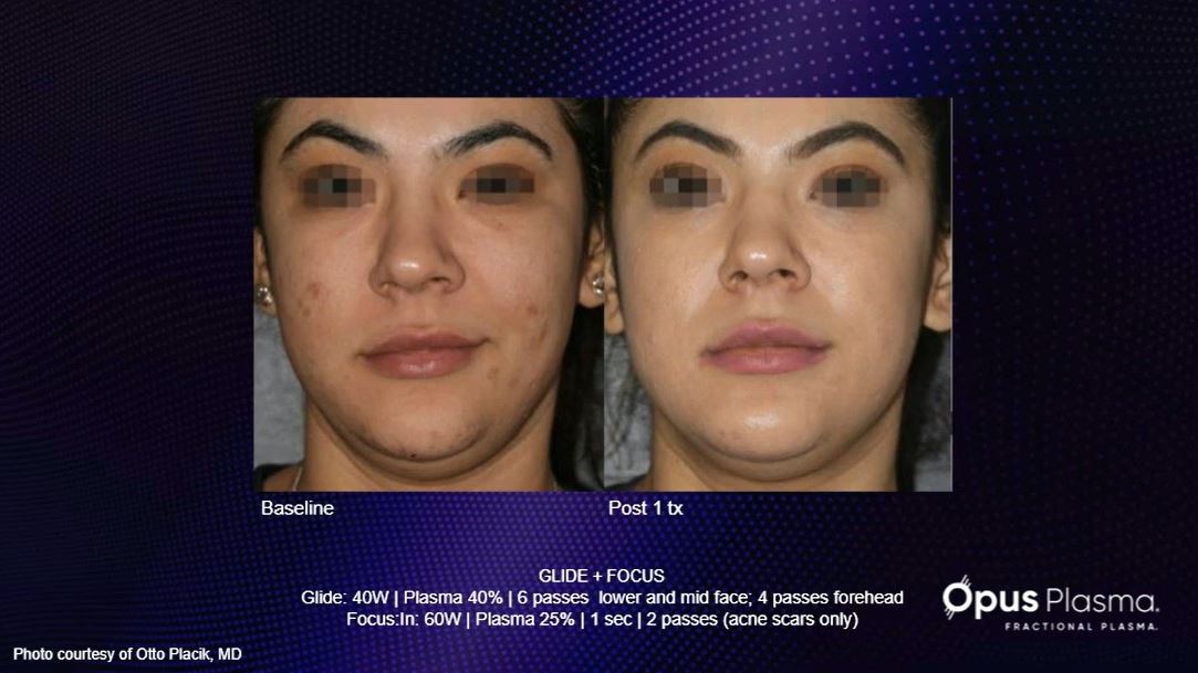 Opus_Acne_Scars_Placik