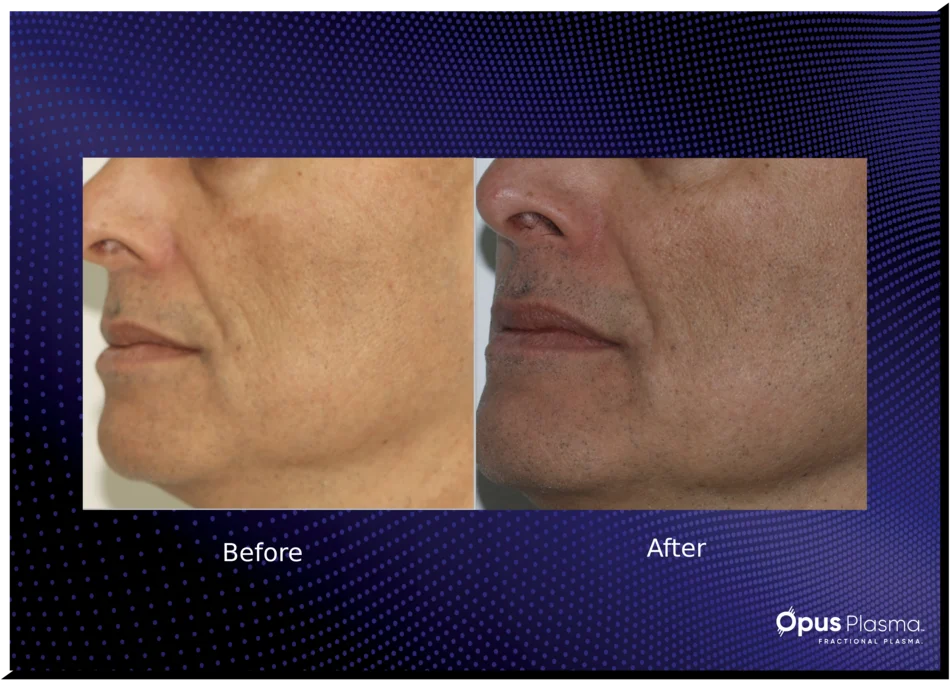 opustiobeforeandafter-1
